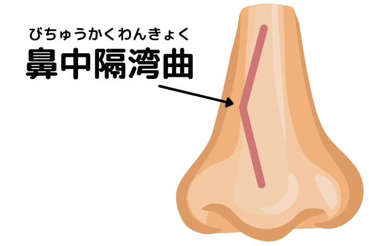 『鼻中隔湾曲症』鼻中隔湾曲の説明画像